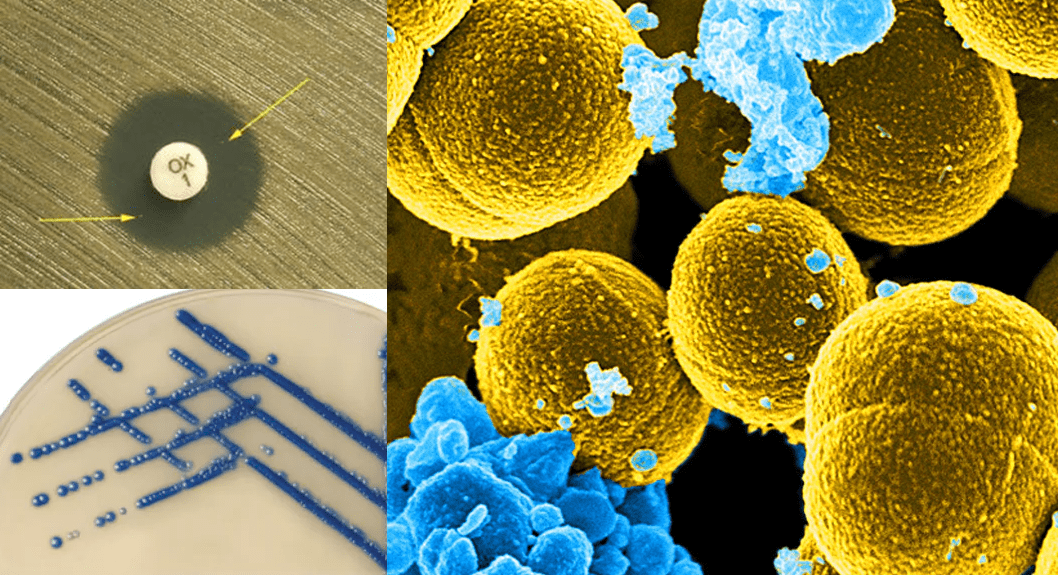 Methicillin-resistant Staphylococcus aureus (MRSA): A Global Health Threat